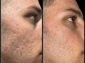 co2 laser acne cicatrices